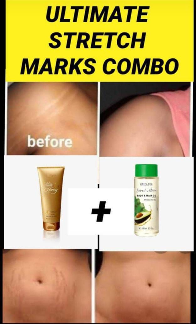 Stretch marks removal